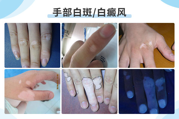 赣州如何有效的护理手部白癜风呢？